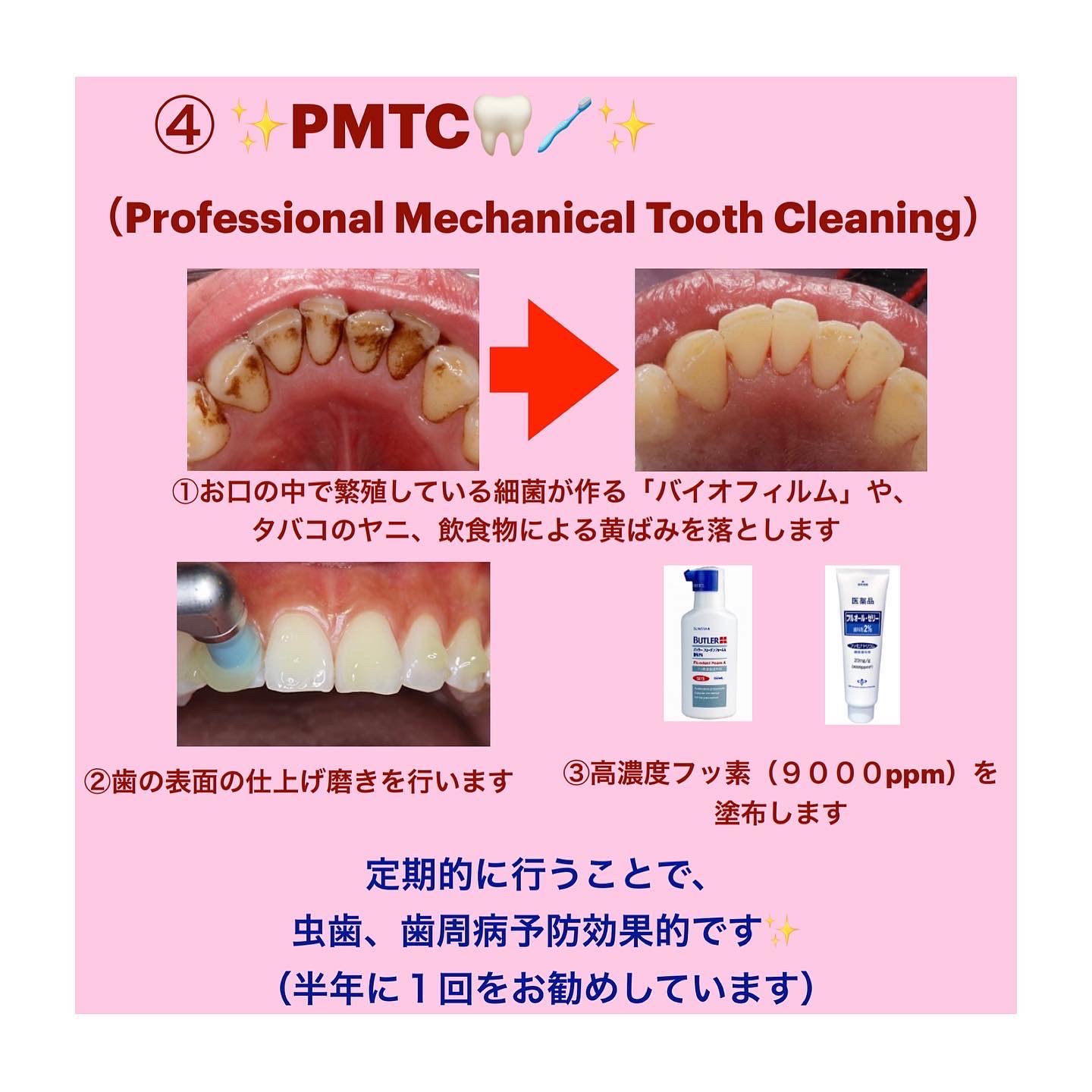 歯 の クリーニング pmtc 料金